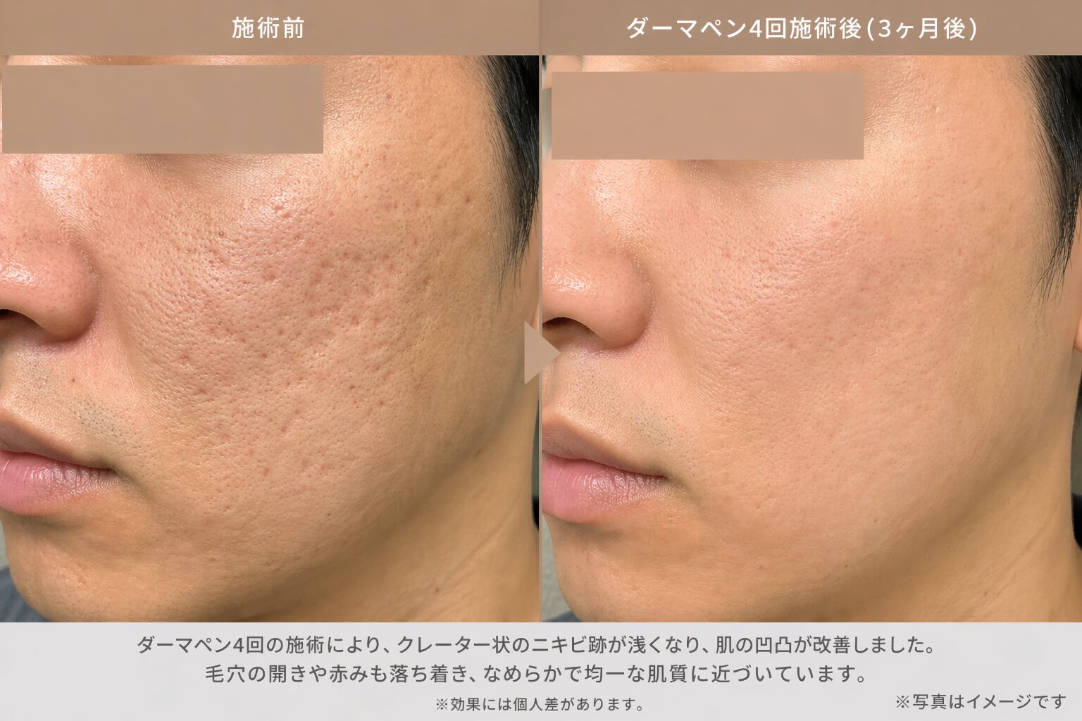 【肌荒れ卒業？】3年塗ったベピオゲルよりダーマペンの物理攻撃が最強だった件【クレーター・ニキビ跡】